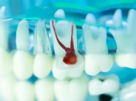 Root Canals – Solution or Problem?